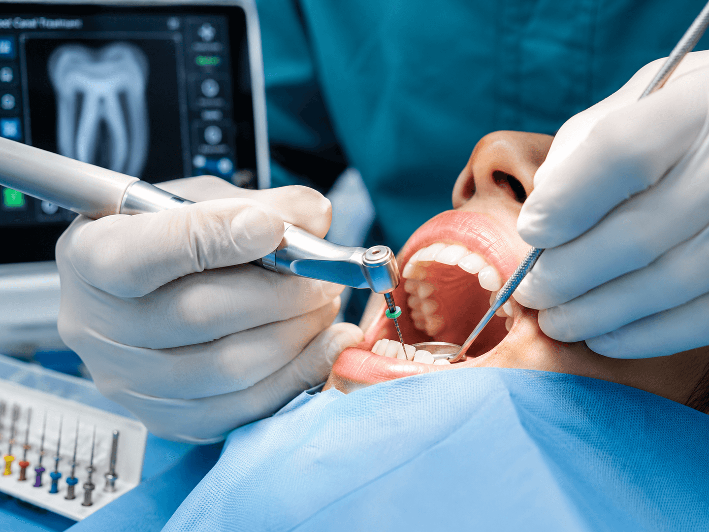 Root Canal Treatment