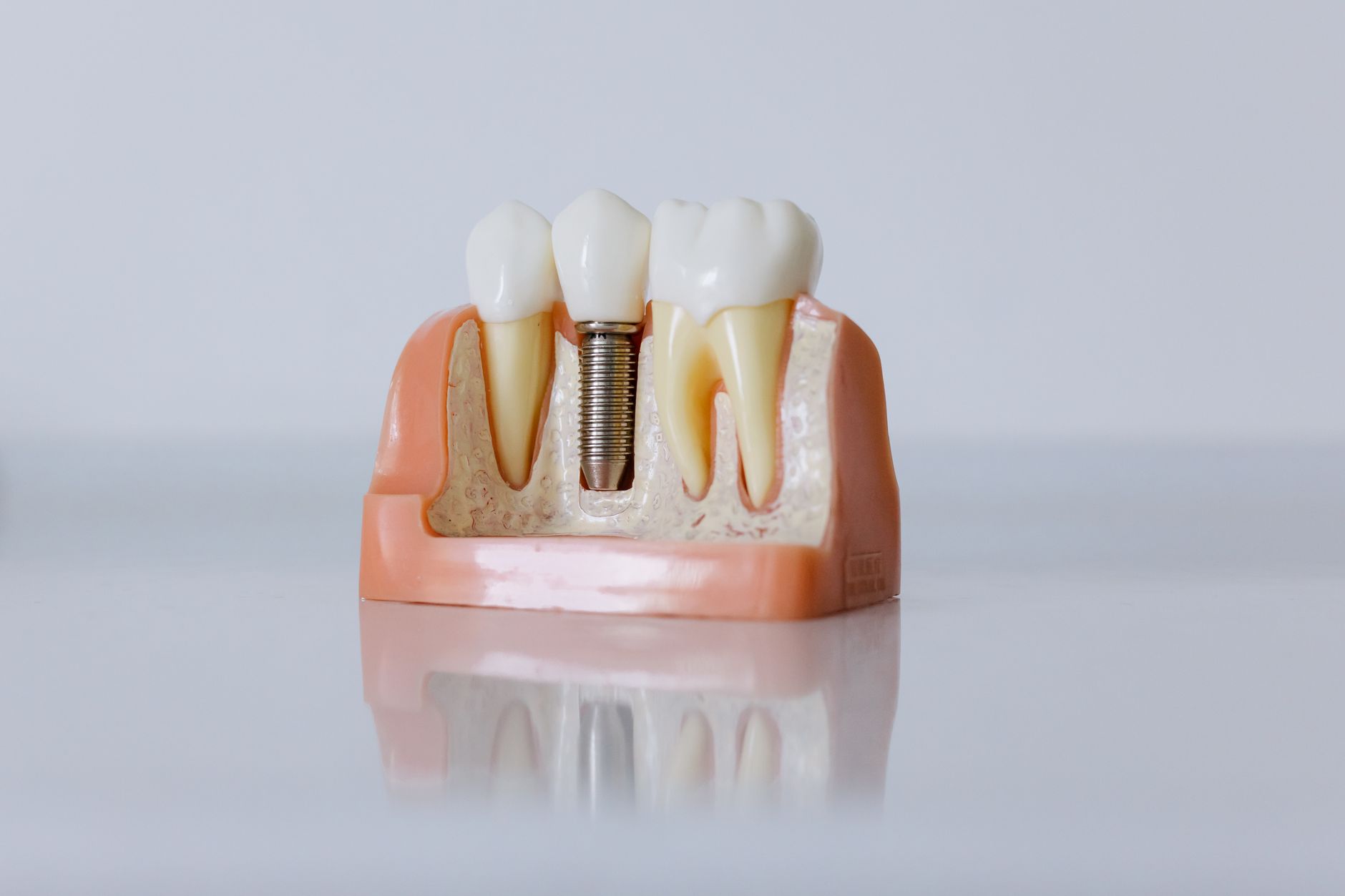 Same day dental implant placement and digital treatment planning in Visakhapatnam at Malatamba Dental Hospital